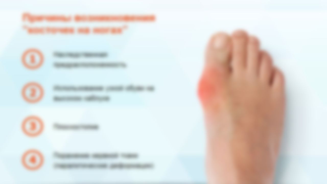 Как убрать шишки на ногах у большого пальца лечение thumbnail